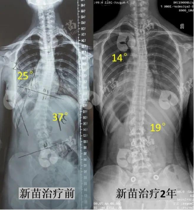 体态调整对预防脊柱问题的重要性研究